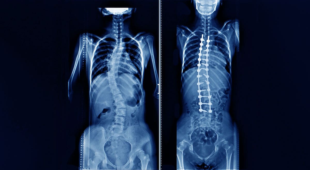 Spinal Deformity Symptoms & Treatments