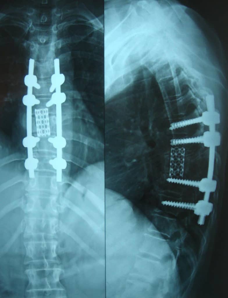Lumbar Disc Degeneration Treatment in Chennai