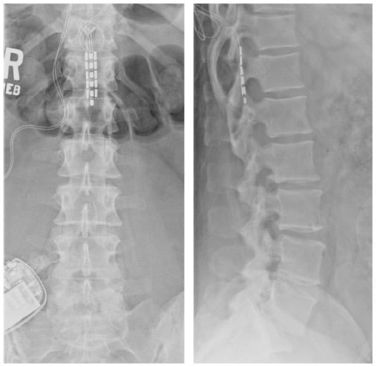 X-ray image of spinal cord stimulator
