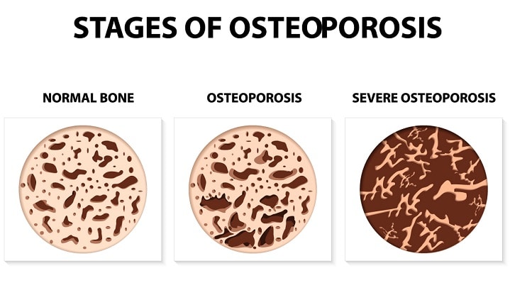 Image explanation about stages of osteoporosis as explained by Dr.G.Balamurali, The best neurosurgeon in India