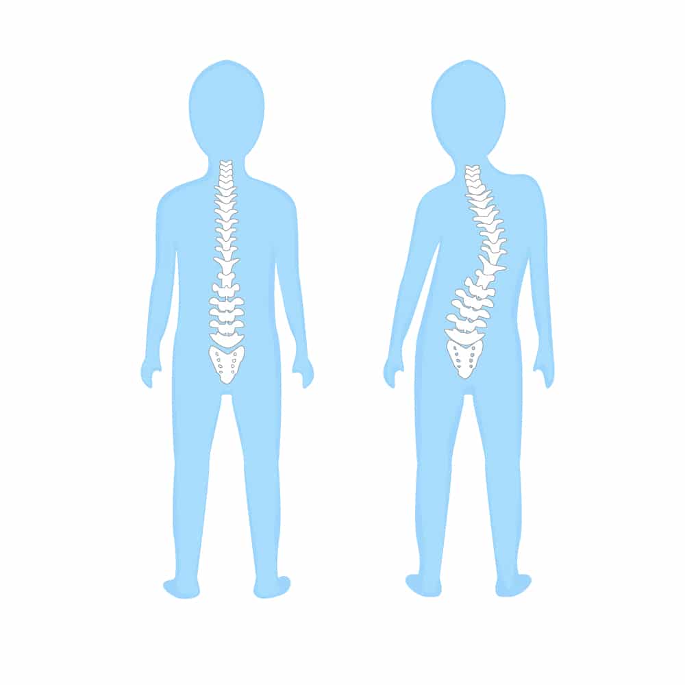 Graphical Explanation of Spinal Deformity