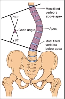 Diagrammatic Explanation of Spinal Deformity